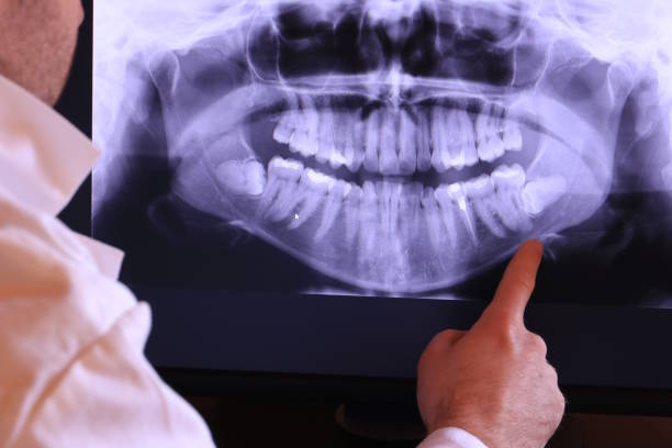 Best Emergency Tooth Extraction in Bluffton, IN