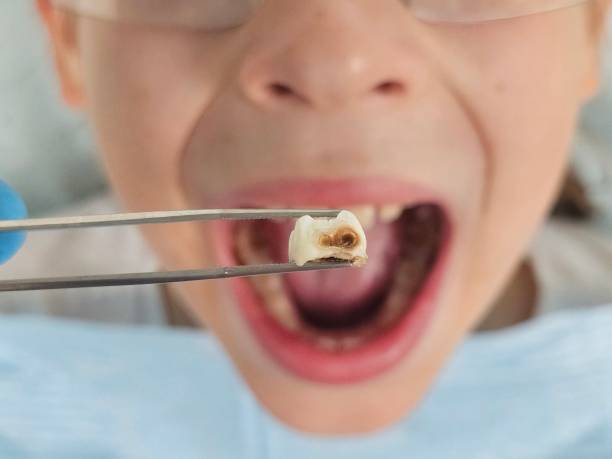 Best Emergency Wisdom Teeth Removal in Bluffton, IN